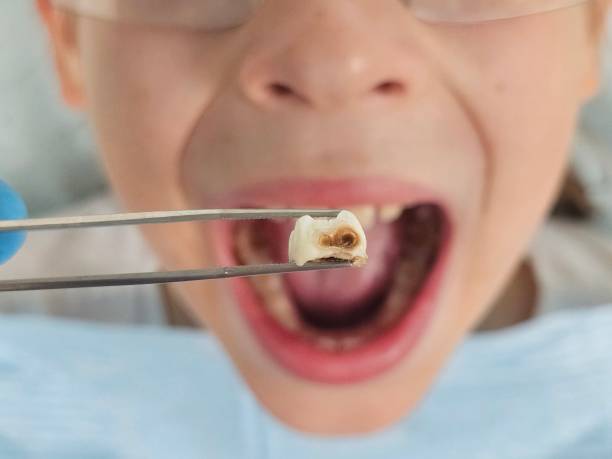 Best Root Canal Emergency Dentist  in Gregory, TX